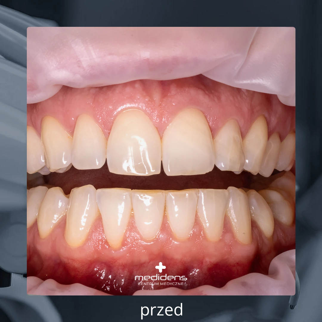 profesjonalne wybielanie zębów częstochowa denstysta