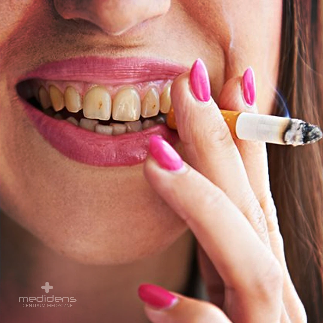 Medidens Częstochowa Dentysta, Klinika, stomatologia - Jak Palenie Papierosów wpływa na Twoje uzębienie