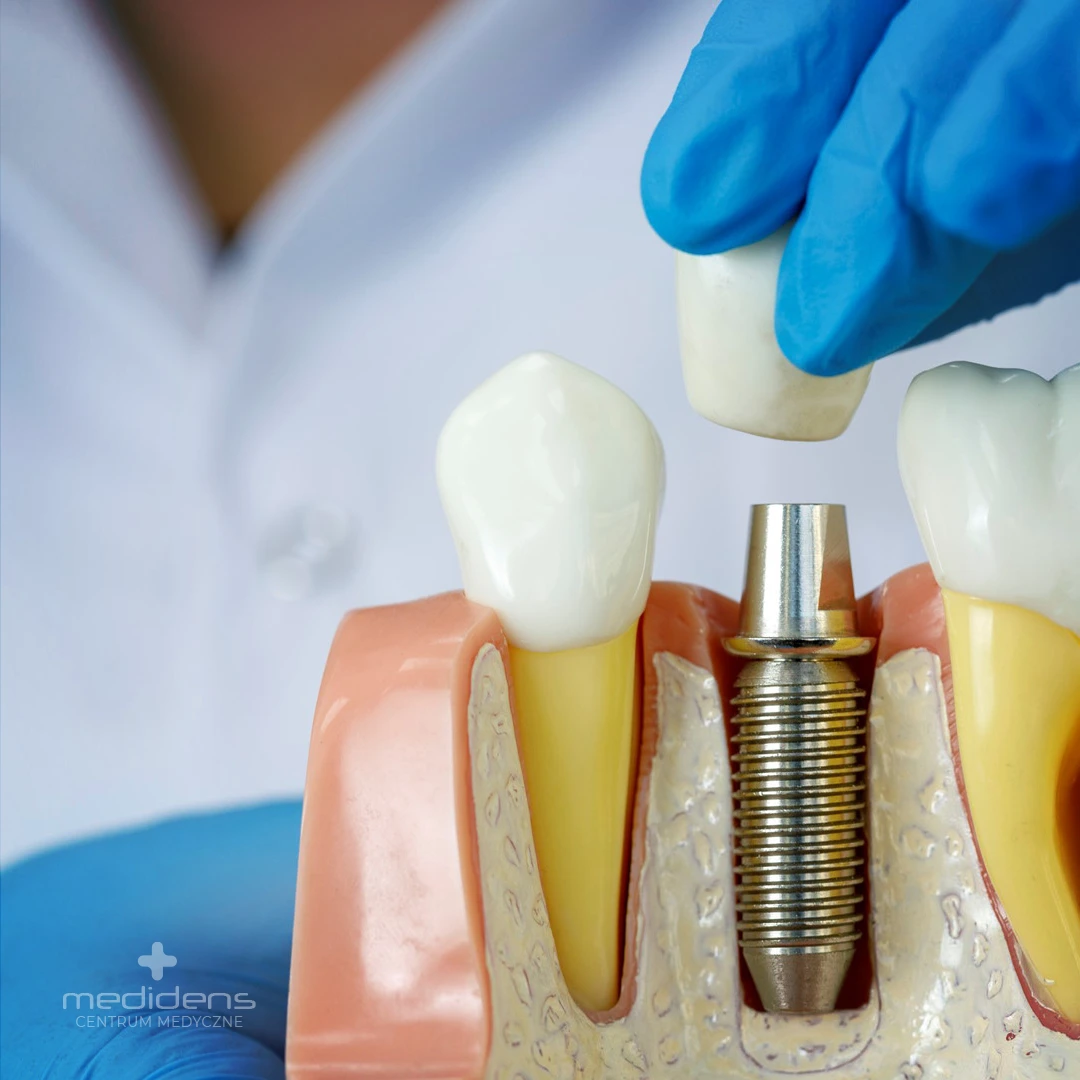 Medidens -Częstochowa, Dentysta, Klinika stomatologiczna - implanty od razu po ekstrakcji zęba