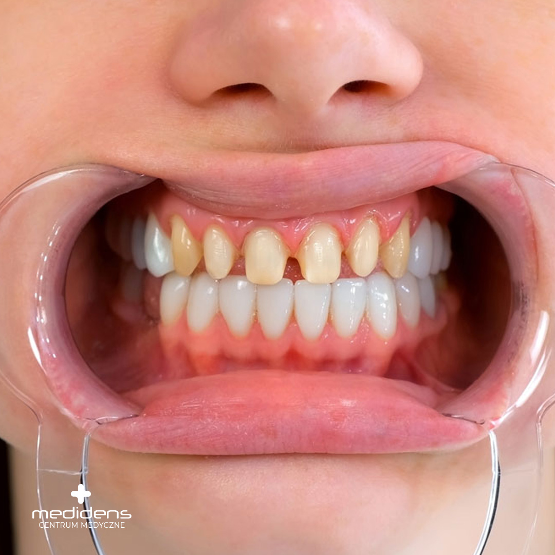 Featured image for “Korony zębowe – Nowoczesne rozwiązania dla pięknego i zdrowego uśmiechu”
